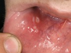 úlcera-bucal